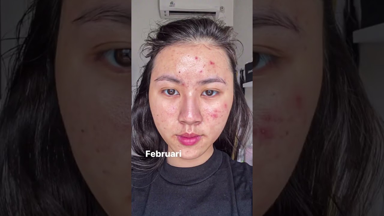 Beginilah kalau punya kulit Acne-Prone Skin🙈