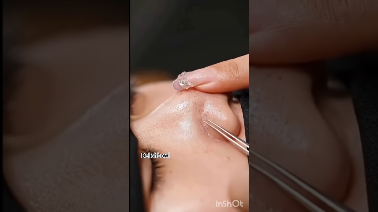 Best DIY Home Remedy for Blackhead Whiteheads Removal Pack #homeremedies #ytshorts #skincare #diy